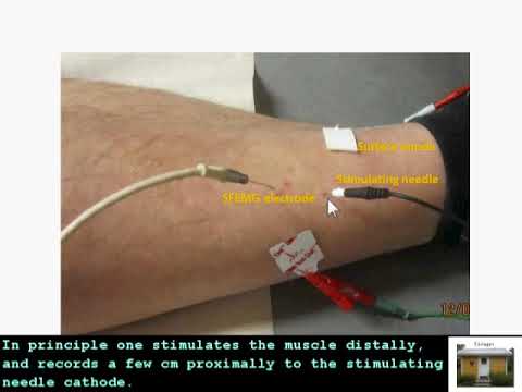 SFEMG - Direct Muscle Stim  (Erik Stalberg)