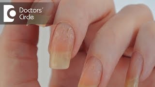 Management of nail pitting - Dr. Aruna Prasad