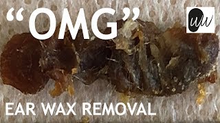 Ear Wax Removal of World’s Largest Piece of Ear Wax Blocking Entire Length of Ear Canal - #397