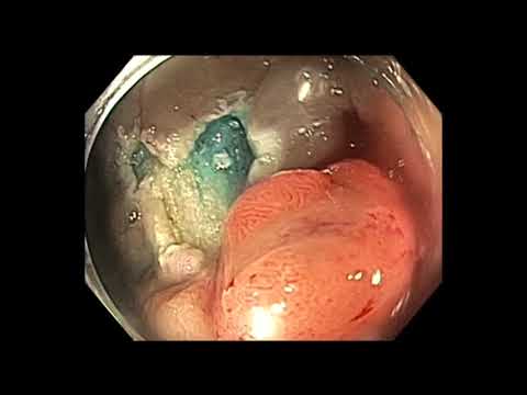 Colonoscopy: Cecal EMR