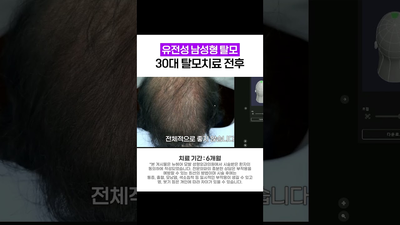 의사도 깜짝 놀란 6개월 탈모치료 전후