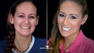 Addiction and Prison to Recovery! Life Changing Extreme Smile Makeover by Brighter Image Lab!