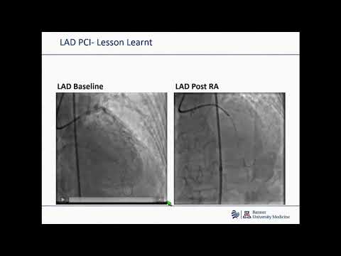 Management of Severe Coronary Calcification - Ashish Pershad, MD