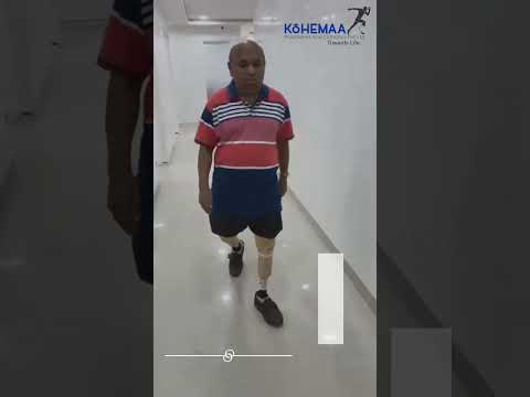 Lower limb below knee prosthesis legs iceross sleeve ossur, ...