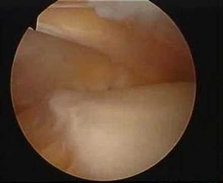 Uzi Hüftarthrose Zervikale Osteochondrose 2-3 Grade behandeln