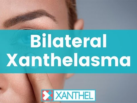 Bilateral Xanthelasma