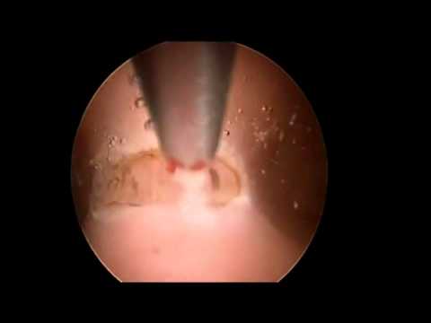 Hysteroscopic Septum || Medicana Konya Tüp Bebek Merkezi̇