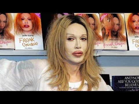 Dead or Alive Lead Singer Pete Burns Dies of Massive Cardiac Arrest at 57
