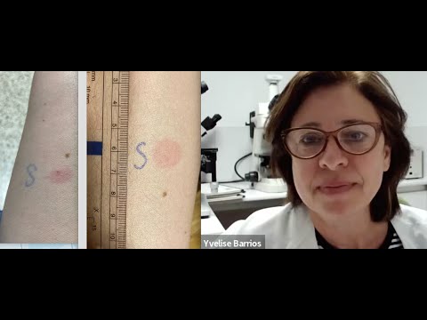 Así es el test cutáneo que podríamos utilizar para saber si necesitamos o no una dosis de refuerzo