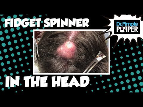 20 Year Old Fidget Spinner In the Head!