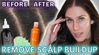 🧀 How I Got Rid Of Scalp Buildup - How To Remove Scalp Buildup & Scalp Exfoliation Favorites