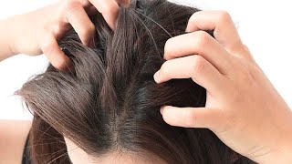 Treatments for Scalp Psoriasis That WORK