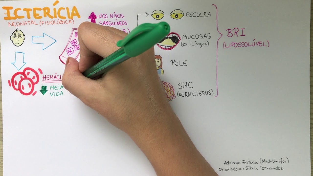 Icterícia Neonatal Fisiológica