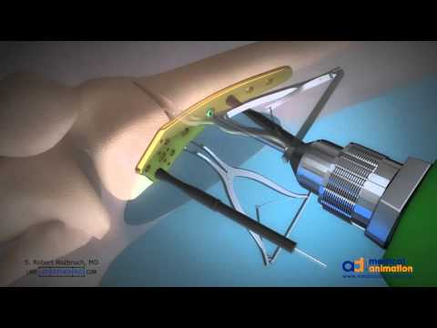 Image - Distal Femoral Ostetomy (DFO) Surgical Animation