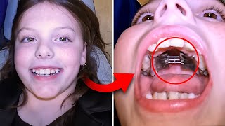Getting an EXPANDER… how does expander work | Orthodontist explains