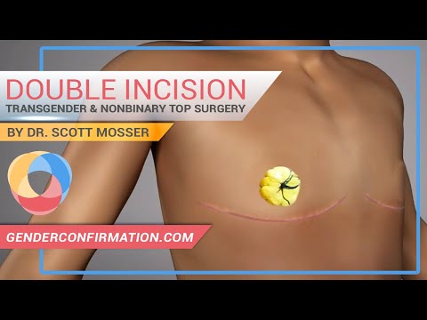 Doppelschnitt-Brustoperation für Transgender und nicht-binäre Personen durch Dr. Scott Mosser