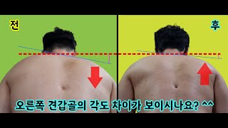 wing scapular 3th(익상견갑 3…