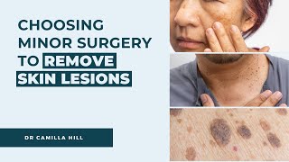 Skin Lesions Removal in Facial Aesthetics Clinic | Dr Camilla Hill