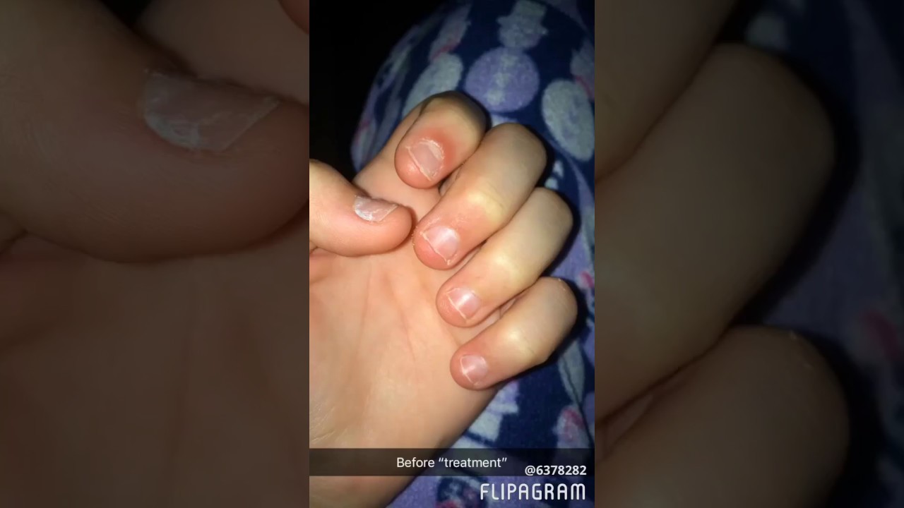 Watch video Nail growth journey 1// day 1 to 80 Now Nail growth journey 1// day 1 to 80