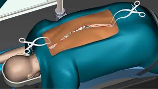 Skolyoz ( Omurga Eğriliği ) Ameliyatı  Nasıl Yapılır.