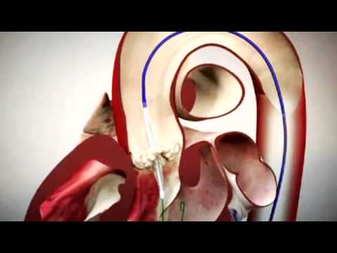 TAVI Procedural Overview