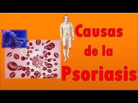La psoriasi che questo e siccome è trattato Le mani a eczema si sono gonfiate