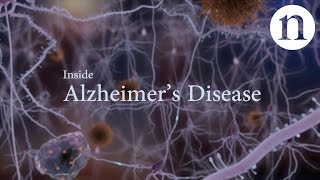 Inflamação, o terceiro elemento da equação do Alzheimer associado à Síndrome de Down