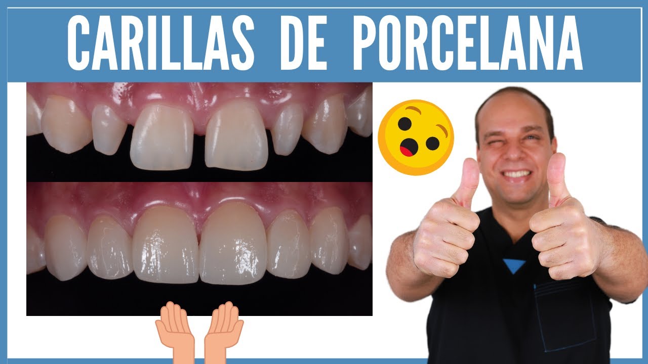 CARILLAS de PORCELANA 😮 [ANTES y DESPUÉS] ⭐ ¡No te Pierdas este CASO que te MUESTRO!