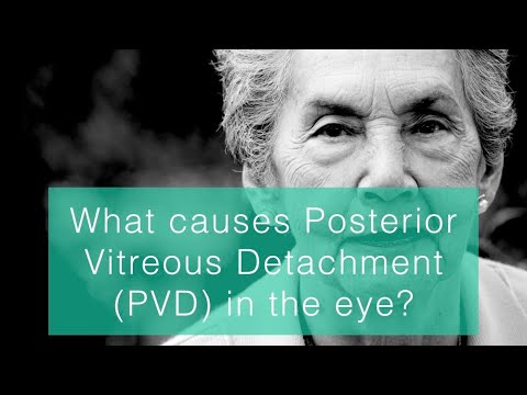 What causes Posterior Vitreous Detachment PVD in the eye?