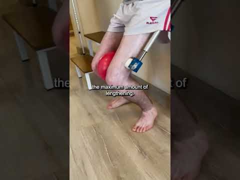 Growing +5.5 CM IN 2 MONTHS with Limb Lengthening Surgery #growtaller