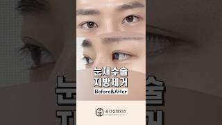 눈 성형에 대한 수 많은 오해! 속 시원히 알려드립니다 (수술 전 시청 필수)