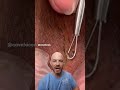 Armpit Cyst And Ingrown Hair Removal Dermreacts Doctorreacts Ingrownhair Satisfying Cystpop