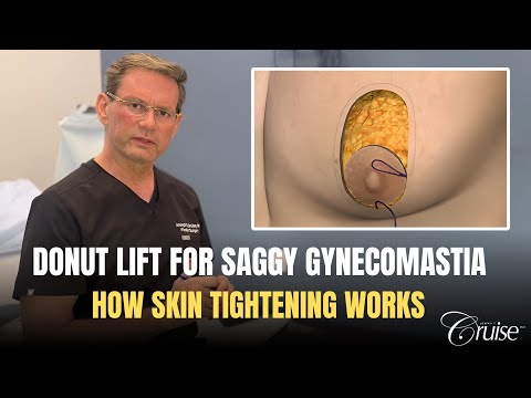 Gynecomastia Animation - Donut Lift