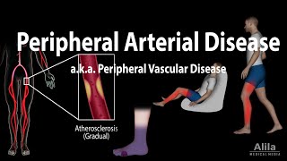 Peripheral artery disease: Pathophysiology, Causes, Symptoms,  Diagnosis and Treatments, Animation