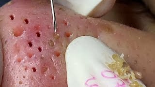 Removing pus from juicy pimples || Relaxing spa video  #9