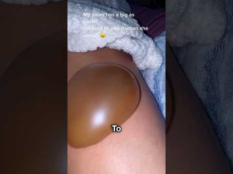 Truth About Blister 😳