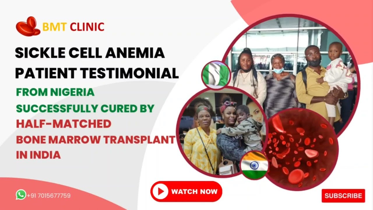 Half Match/ Haploidentical Bone Marrow Transplant in India of Nigerian Sickle Cell patient