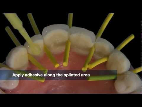 Дентапрег, лента для шинирования, Dentapreg Splint SFM (ADM DENTAPREG) - фото 1 - id-p2182289495