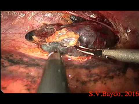 Thoracoscopic Biopsy