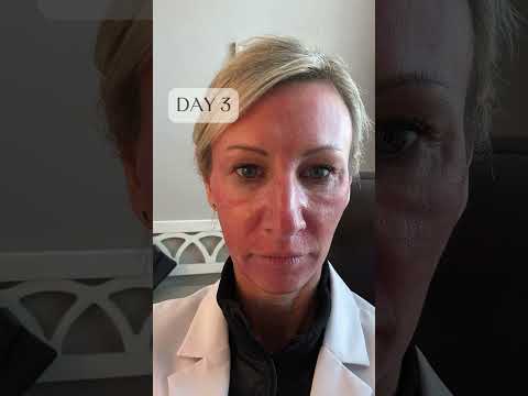 😱 The recovery behind a CO2 laser skin resurfacing! Don't worry, it's worth every day of recovery 😉