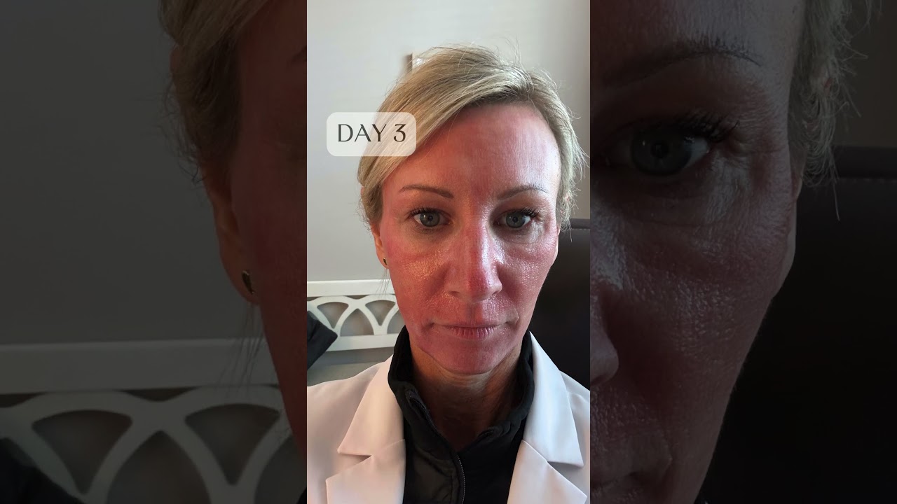 😱 The recovery behind a CO2 laser skin resurfacing! Don't worry, it's worth every day of recovery 😉