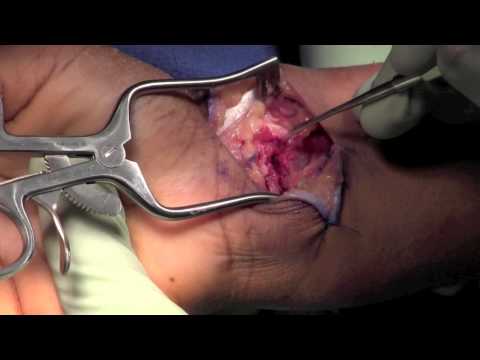 Distal Radius Open Reduction Internal Fixation with Carpal Tunnel Release