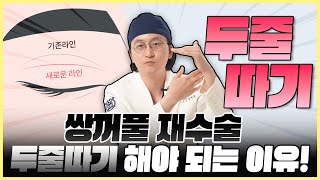 두줄따기가 가능한 눈이 따로 있다고?? I 브이엔성형외과 I