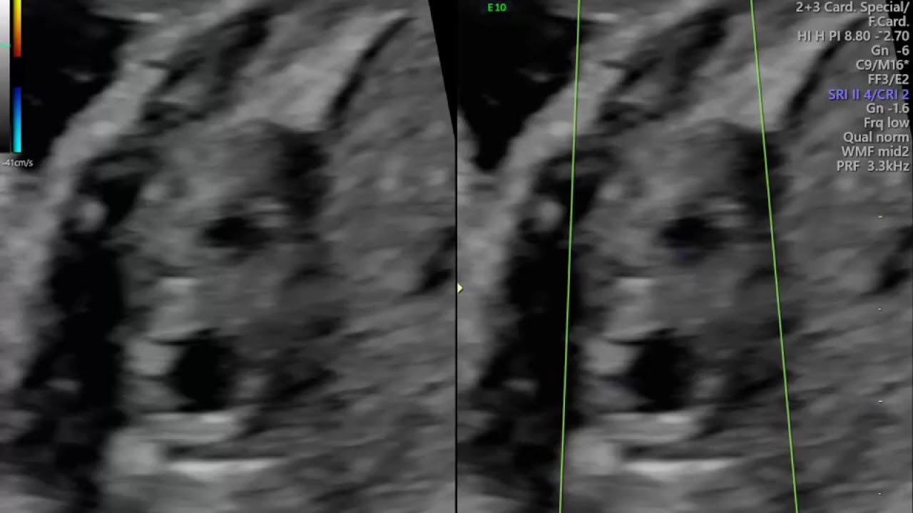 ECOCARDIOGRAFIA FETAL COM AVALIAÇÃO DE CAMARAS CARDIACAS