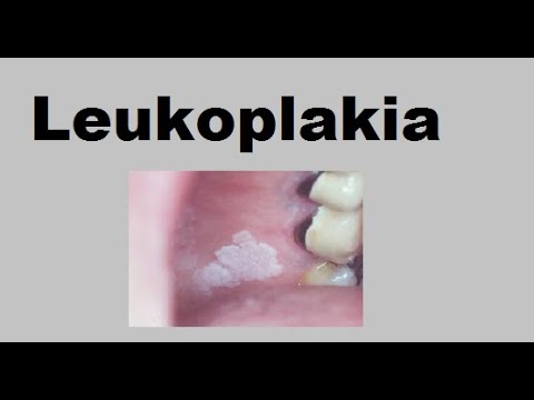 leukoplakia a péniszen