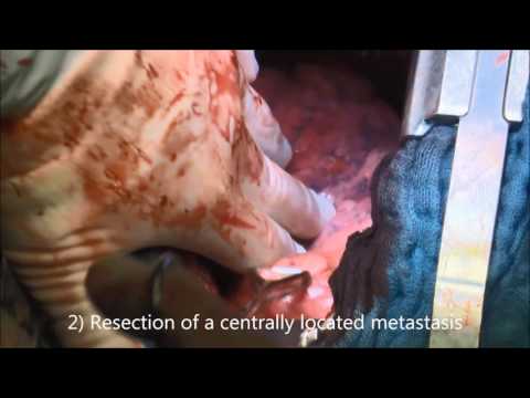 Limax® – Animation open thorax surgery