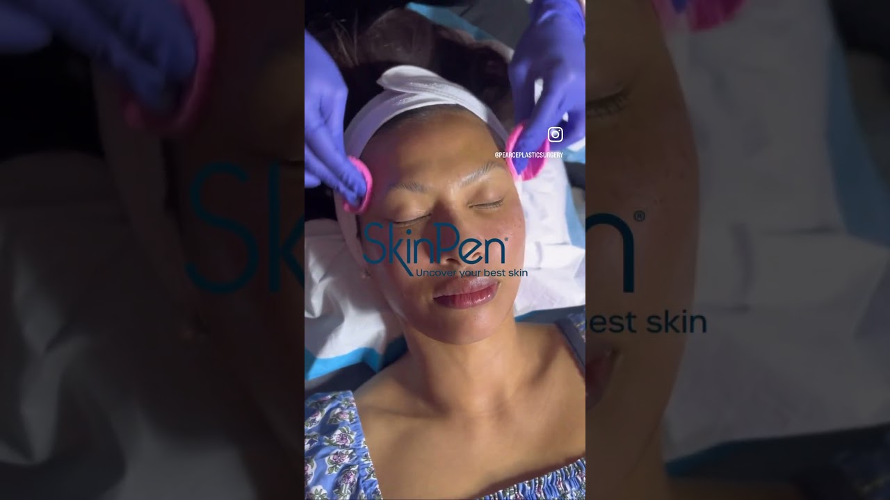 Microneedling with SkinPen | Austin, TX Microneedling|