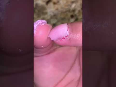 MY WHOLE NAIL RIPPED OFF…😱🤢 (UPDATE)