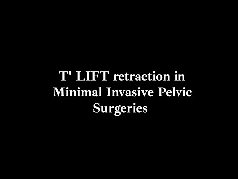 T'Lift retraction in minimal-invasive pelvic surgeries