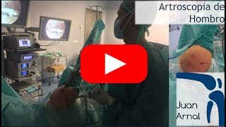 Artroscopia Hombro: Acromioplastia